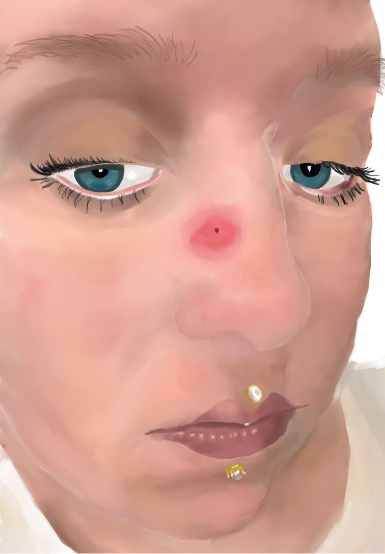A womans face with a large red bug bite on her nose