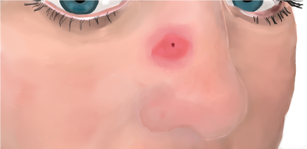 A close up of a painting of a woman with a large bug bite on her nose